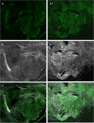 Comparación entre diferentes tinciones: A) fluorescencia con naranja de acridina; A1) fluorescencia con naranja de acridina y ácido acético; B) reflectancia con naranja de acridina; B1) reflectancia con naranja de acridina y ácido acético; C) fusión con naranja de acridina; C1) fusión con naranja de acridina y ácido acético.