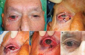 Exéresis en pentágono. a) Carcinoma basocelular en el párpado inferior derecho en un varón de 85 años, con un ectropión de componente mixto, involutivo y mecánico secundario al tumor. b y c) Se diseñó la exéresis del tumor en pentágono permitiendo cumplir con el objetivo oncológico y reconstructivo, al evitar el ectropión por la reducción del componente horizontal palpebral. Resultado de la técnica en el postoperatorio inmediato d) y a las 8 semanas e).