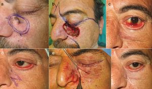Z-plastia. a) Paciente de 54 años con un carcinoma espinocelular en la región infraorbitaria. b) Defecto quirúrgico y diseño de la reconstrucción mediante un colgajo combinado glabelar y pangeniano. c) Ectropión severo posquirúrgico multicomponente, con elementos cicatriciales, pérdida de volumen e involutivo, sintomático, con lagoftalmos y hemorragia conjuntival acompañante. d y e) Para su corrección se procedió a la liberación de la tensión vertical cicatricial mediante una z-plastia. f) Postoperatorio tardío (a las 8 semanas): reposicionamiento del párpado inferior.