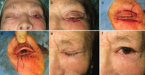 Colgajo de Tripier. a) Ectropión posquirúrgico traccional con falta de volumen en párpado inferior. b) Diseño de colgajo de transposición de párpado superior o colgajo de Tripier. c) Posicionamiento final del colgajo tras realización de incisión inmediatamente inferior a la línea de las pestañas en párpado inferior, disección y transposición del colgajo. d) Postoperatorio inmediato. e y f) Postoperatorio tardío a las 8 semanas.