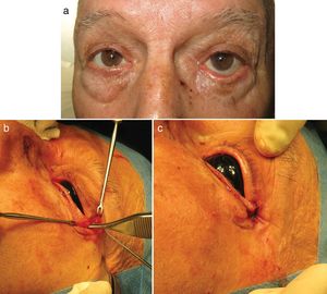 Cantopexia. a) Ectropión posquirúrgico mixto (involutivo y mecánico secundario a retracción del injerto empleado para la reconstrucción tras la extirpación de un carcinoma basocelular). b) Liberación del tejido retráctil y realización de incisión de 1cm a 0,3-0,5cm del canto externo y disección hasta localizar el ligamento cantal externo. c) Fijación del ligamento cantal a la cara interna del periostio del reborde orbitario mediante sutura monofilamento reabsorbible de 5/0.