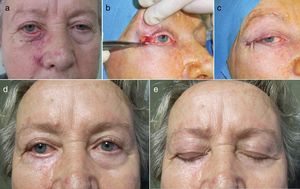 Cantoplastia. a) Eversión posquirúrgica del párpado inferior en una mujer de 65 años con laxitud horizontal moderada-severa. b) Cantoplastia lateral para el reposicionamiento palpebral: incisión horizontal de 1cm en la lamela anterior a través del canto externo, dejando expuesto el ligamento cantal. Localización del punto de tensado que corregiría el defecto y fijación del ligamento al periostio de la cara interna del arco orbitario con una sutura reabsorbible 5/0, a una altura 2mm superior a la del canto interno. c) Sutura de la piel mediante cierre directo con seda de 5/0 (fig. 7b y c). d y e) Buen resultado funcional y estético a las 8 semanas.