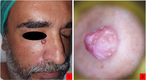 1) Nódulo rojo de superficie lisa en tercio superior del surco nasogeniano derecho; 2) Dermatoscopia. Lecho rojo-blanquecino con vasos telangiectásicos irregulares y áreas blanco-algodonosas.