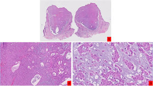 1) Imagen panorámica donde se observa un tumor dérmico de límites bien definidos y ligera retracción periférica (H&E, ×10); 2) A mayor detalle se observan células cuboideas de citoplasma eosinófilo, sin atipia citológica, que se disponen en cordones y formando estructuras tubulares (H&E, ×20); 3) Focalmente, el estroma adquiere una diferenciación condroide y mixoide (H&E, ×40).