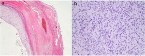 a)Hematoxilina-eosina (HE) ×20: focos de hemorragia en el estrato córneo de la epidermis. b)HE ×40: en el centro de la imagen se observan células mioides siguiendo una distribución perivascular.