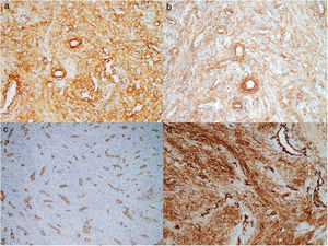 Estudio inmunohistoquímico: positividad para: a)caldesmon (×40); b)actina (×40); c)CD31 (×20), y d)CD34 (×40). En c) y d) se ven las células mioides dispuestas de manera concéntrica a los endotelios.