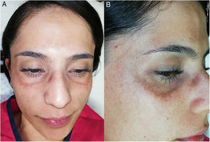 A) Bilateralidad y simetría de las lesiones en la región infraorbitaria. B) Acercamiento destacando máculas moteadas de tono gris-marrón, que tienden a formar una placa.