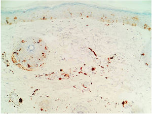 Melanocitos dérmicos fusiformes entre fibras de colágeno y perivasculares (S100 positivo, ×20).