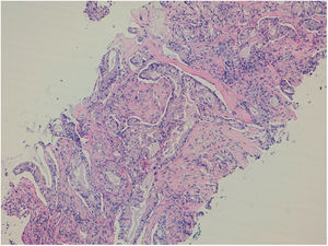 Adenocarcinoma metastásico de pulmón. Cilindro de la BAG 18G, tinción H&E.