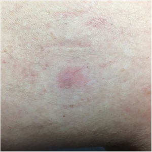 Mácula eritematosonrosada rodeada por un halo pálido.
