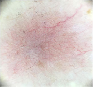 Dermatoscopia que muestra un fino reticulado telangiectásico y zona azul grisácea mal definida.