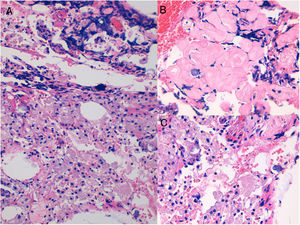 Hematoxilina-eosina: A) se observa una intensa reacción granulomatosa a cuerpo extraño (×20); B) material eosinofílico (×40); C) material basofílico (×40).