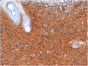 Inmunohistoquímica con positividad para CD34, ×100.