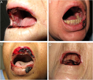 Mucositis por metotrexato. Erosiones y costras necróticas. A) Caso 1. B) Caso 2. C) Caso 3. D) Caso 4.