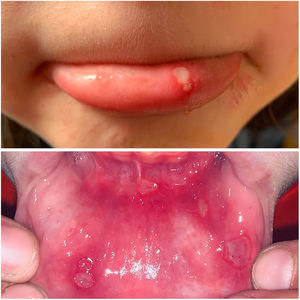 Imagen de aftas minor en labio y mucosa de labio inferior.