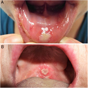 A. Afta major en mucosa de labio inferior. B. Afta en paladar blando.