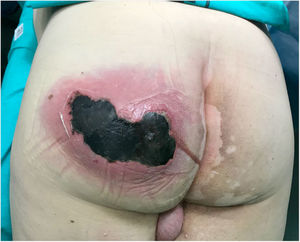 Imagen clínica de absceso en glúteo izquierdo con supuración activa y amplia zona de necrosis de 10 cm