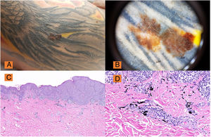 A) Lesión pigmentada con alteración de los criterios clínicos ABCD en el brazo derecho sobre tatuaje. B) Dermoscopia (DermLite® DL3) ×10: Lesión melánica con áreas de regresión, retículo pigmentado roto y atípico, asimetría y policromía manifiesta, confirmada histológicamente con melanoma de extensión superficial, Breslow 0,25mm. C) H&E, ×2: Panorámica de melanoma de extensión superficial con distribución pagetoide. D) Melan A: Detalle de tinción de melanoma y pigmento en dermis superficial.