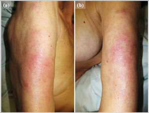 Presentación clínica: placas mal definidas, eritematosas e infiltradas, localizadas en la superficie extensora del brazo derecho (a) e izquierdo (b) del paciente, que además eran dolorosas a la palpación.