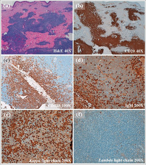 Hallazgos histopatológicos en la biopsia cutánea. A nivel dérmico y subcutáneo se observaba la presencia de una infiltración densa y difusa, compuesta por linfocitos pequeños, células linfoplasmocitoides y células plasmáticas (a), resultando además las tinciones positivas para el CD20 (b), el CD138 (c) y la IgM (d), limitada a la cadena ligera kappa (e,f). Estos datos en su conjunto confirmaron la afectación cutánea neoplásica por una macroglobulinemia de Waldenström.