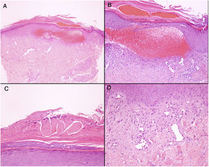Hematoxilina-eosina (A x10, B y C x20, D x40).