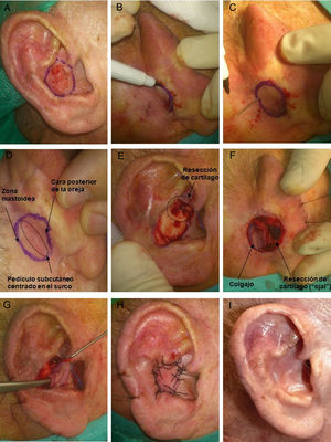 A) Varón de 80 años con un carcinoma epidermoide de 1,5cm en concha auricular derecha. Delimitación del margen de resección. B y C) Diseño del colgajo en la zona retroauricular. Para su delimitación se puede atravesar una aguja por los bordes del defecto quirúrgico, desde la cara anterior hacia la zona retroauricular. D) Colgajo diseñado. La zona correspondiente al pedículo subcutáneo debe quedar centrada en el surco aurículo-temporal. E) Extirpación del tumor. Además, se debe realizar la resección de una zona del cartílago auricular, la cual hará de «ojal» para atravesar el colgajo hacia la zona anterior. F) Colgajo disecado por sus bordes unido en su zona central al surco. G) Mediante erinas se pasa el colgajo hacia la zona anterior de la oreja. H) Sutura del colgajo con seda 3/0. I) Resultado a los 4 meses de la cirugía.