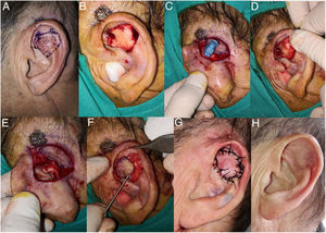 A) Varón de 72 años; presenta un carcinoma basocelular de 1,8cm en las raíces del antihélix y fosillas triangular y escafoidea izquierda. B) Extirpación del tumor respetando cartílago subyacente. C-E) La transfixión con aguja en el márgen de resección nos marca el área donde diseñar el colgajo y resecar cartílago. F y G) El colgajo es movilizado hacia la cara anterior de la oreja y fijado mediante puntos simples. En la zona retroauricular del sitio donante se realiza un cierre directo. H) Resultado a los 1,5 meses de la cirugía manteniendo estructura y funcionalidad.