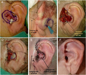 A) Mujer de 70 años; presenta un complejo tumor tipo carcinoma basocelular, de 2,5cm de diámetro, que afecta a 4 zonas (concha, raíz de hélix, trago y zona preauricular). B) Diseño del CIPG. La colocación de suturas largas en el hélix permite realizar tracción anterior del pabellón auricular y mejorar la visualización del campo quirúrgico. C) Tumor extirpado. D y E) El trago, la raíz de hélix y la zona preauricular se reconstruyen mediante un colgajo de avance, mientras que en la concha auricular se realiza un colgajo en isla en puerta giratoria. F) Resultados de la cirugía a los 8 meses. Sin recurrencia a los 8 años de seguimiento.