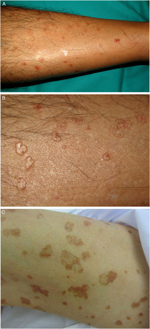 A-B. Poroqueratosis actínica superficial diseminada. Múltiples placas marronáceas anulares bien delimitadas con borde solevantado en las piernas. C-D. Poroqueratosis superficial diseminada. Placas marronáceas bien delimitadas con borde solevantado en el muslo derecho.
