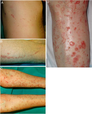 A-B. Poroqueratosis lineal. Placas eritematomarronáceas de borde descamativo y trayecto lineal en el costado derecho (A) y muslo izquierdo (B). C-D. Poroqueratosis diseminada eruptiva. Múltiples placas de borde anular eritematoso e hiperqueratósico en ambos brazos (C) y en la pierna izquierda (D), las lesiones eran intensamente pruriginosas.