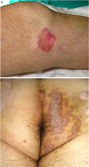 A. Poroqueratosis de Mibelli. Placa redondeada eritematosa de 4 cm con borde elevado e hiperqueratósico en la rodilla izquierda. El estudio histológico confirmó el diagnóstico. B. Poroqueratosis ptychotropica. Múltiples placas eritematodescamativas confluyentes de borde hiperqueratósico en zona perianal y glúteo derecho.