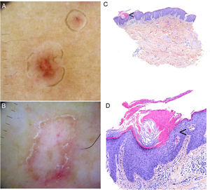 Poroqueratosis. A-B. Dermatoscopia. Lesión eritematomarronácea sin estructuras claramente definidas con borde anular marronáceo (A). Lesión con zonas blancas sin estructura y vasos puntiformes, con borde anular hiperqueratósico. Se puede observar el signo del «doble riel» (B) (3 Gen Dermlite DL200, x8). C-D. Histología. C. Invaginación epidérmica y presencia de columna de paraqueratosis (lamela cornoide) (flecha) (H-E, x40). D. Lamela cornoide. Nótese la ausencia de la capa granulosa en la base de la columna paraqueratósica (flecha), junto a la presencia de queratinocitos disqueratósicos en el estrato espinoso (H-E, x200). Lamela cornoide (flecha) (H-E, x100).