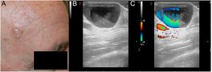 Caso 2. A) Imagen clínica: nódulo traslúcido en la sien derecha. B) Imagen US. Modo-B: lesión quística hipoecoica. C) Imagen US. Doppler-color: Doppler color turbulento.