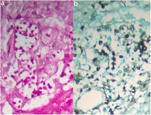 a) Coloración con hematoxilina eosina 400×. Obsérvese epitelio ulcerado con hiperplasia, infiltrado inflamatorio mixto en un estroma fibroso y mucoide con granulomas de histiocitos de citoplasma amplio y claro, llenos de levaduras de diferentes tamaños y formas, algunas de aspecto encapsulado; b) coloración con mucicarmina 400×. Positividad en la cápsula de las levaduras.