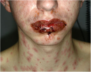 Síndrome de Stevens-Johnson. Mucositis grave. Edema y múltiples erosiones en los labios.