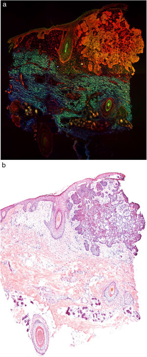 Carcinoma basocelular estudiado mediante microscopía confocal de fluorescencia a color (a). Nótese la correlación con las imágenes de hematoxilina-eosina clásicas (b).