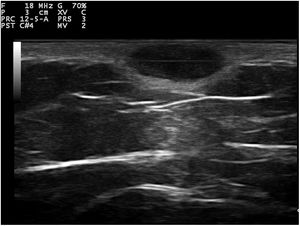 Hallazgos ecográficos.