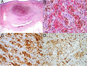 A) Hematoxilina-eosina, 2 x; 3. B) Hematoxilina-eosina, 40x 3. C) CD68, 40x; 3. D) CD34, 40x.