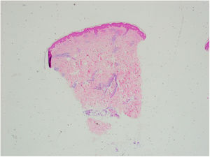 Imagen panorámica de la biopsia teñida con H&E. La epidermis está conservada. Se advierte el infiltrado inflamatorio perivascular y perianexial en dermis que alcanza el tejido celular subcutáneo.