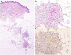 a) Imágenes histológicas que muestran la vasculitis necrosante en el subcutis. b) Imagen de gran aumento que reveló necrosis fibrinoide subíntima. c) Lámina interna parcialmente interrumpida (flecha) (tinción elástica van Gieson).