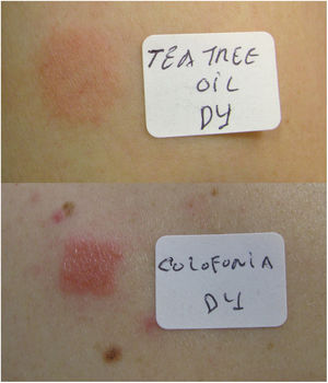 Pruebas epicutáneas positivas (D4) para el aceite del árbol del té y para la colofonia (caso 2).