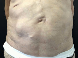 Resolución completa de la pseudohernia tras 8 meses de seguimiento.