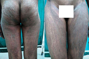 Eritema flagelado y pápulas lineales con escamas que muestran el fenómeno de Koebner en glúteos (imagen izquierda) y muslos (imagen derecha).