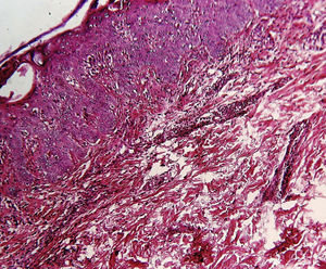 Histología de la piel que muestra microabscesos en el estrato córneo con queratinocitos necróticos e infiltrado inflamatorio perivascular y perianexial (aumentos originales 100x, tinción de hematoxilina-eosina).