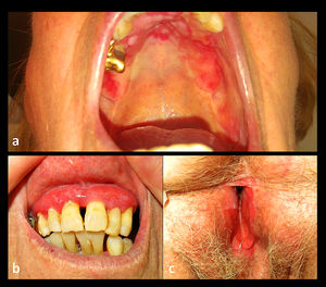 Imágenes clínicas. Erosiones en el paladar duro a) y una gingivitis erosiva b) en ausencia de estrías liquenoides. Erosiones en la mucosa genital c) con desaparición de los labios menores y formación de sinequias.