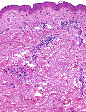 La biopsia muestra un infiltrado inflamatorio perivascular compuesto principalmente por linfocitos, que afectaba a la dermis superficial y media (H&E).