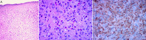 Biopsia de piel: A y B) Infiltrado dérmico de histiocitos y eosinófilos (H/E 40x y 100x, respectivamente). C) Inmunohistoquímica: marcador CD68 positivo.