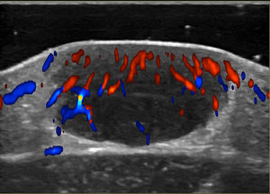 Ecografía doppler color: se observa una formación nodular dérmica que solevanta la epidermis, hipoecogénica, de aspecto sólido y de contornos bien delimitados. En su interior se distingue mediano grado de vascularización.