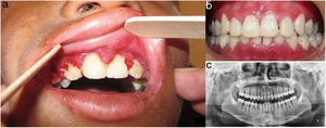 Evaluación odontológica del caso 1. a) Gingivitis, periodontitis e hiperplasia gingival (bolsas y seudobolsas periodontales) en presencia de placa bacteriana y cálculo dental; movilidad grado 1 en dientes anteriores. b) Vista en oclusión postratamiento: se evidencia mejoría clínica significativa. c) Radiografía panorámica evidenciando resorción horizontal de crestas interdentarias.