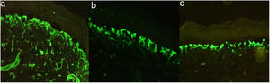Inmunofluorescencia del caso 1. Patrón de tinción reticulado positivo en la membrana dermoepidérmica para colágeno iv (a), colágeno vii (b) y laminina 332 (c); patrón característico de síndrome de Kindler.